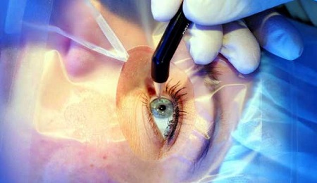 operacion ojos